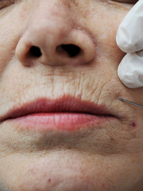 Pušačke Linije Dermalni Fileri